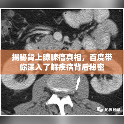 揭秘肾上腺腺瘤真相，百度带你深入了解疾病背后秘密