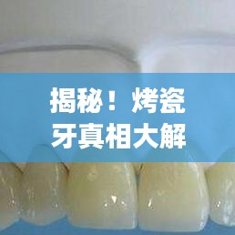 揭秘！烤瓷牙真相大解密，专业解读烤瓷牙的优缺点