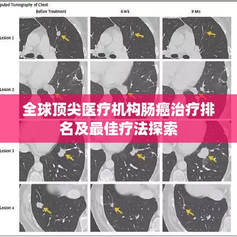 全球顶尖医疗机构肠癌治疗排名及最佳疗法探索