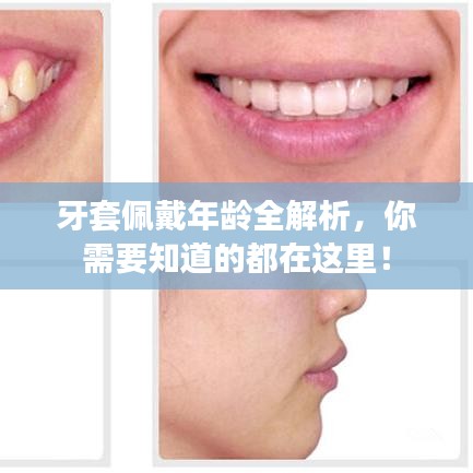 牙套佩戴年龄全解析，你需要知道的都在这里！