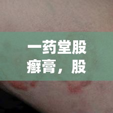 一药堂股癣膏，股癣的克星，专业解决方案
